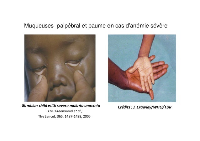 anémie est ce grave anémie est ce grave